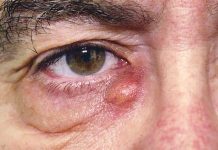 Dry Eyes and What You Can Do About Them