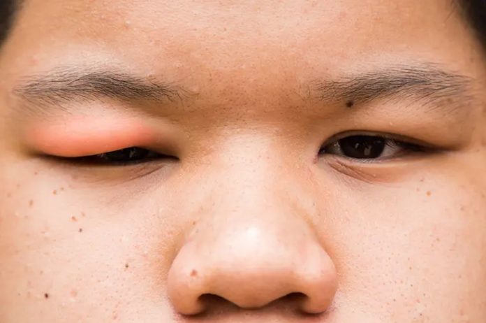 Swollen Eyelid