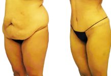 What Is a Tummy Tuck Procedure?