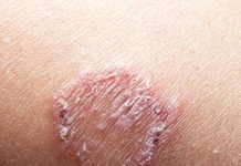 Skin Infections: What You Should Know
