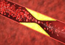 Myths and Facts About Managing High Cholesterol
