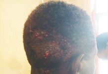 Police Probe Injuries To 5 Former Electrochem Workers