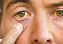 Fear Grips Upper West As Yellow Fever Confirmed 30 Deaths