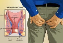 Hemorrhoids: Symptoms, Causes, And Treatment